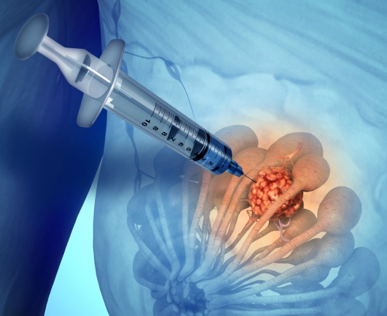 Биопсия молочной железы